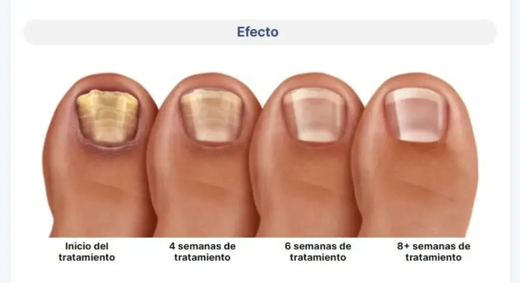 Aplicación de Foot Trooper para eliminar hongos