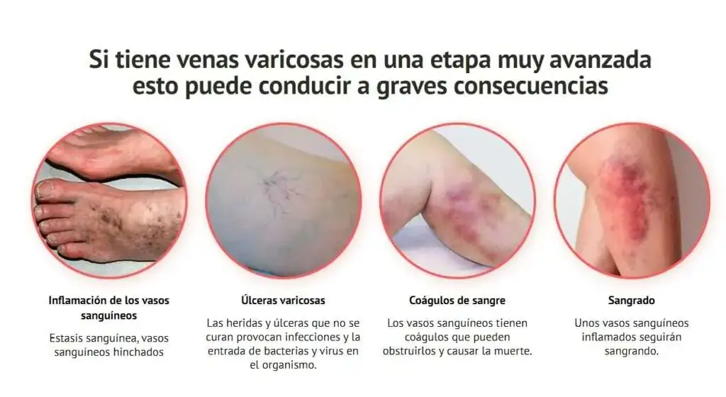 Veniselle crema para varices en México